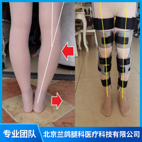 北京腿部塑形矫正 X型腿O型腿腿型矫正