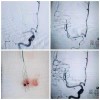 腦動脈取栓術(shù)