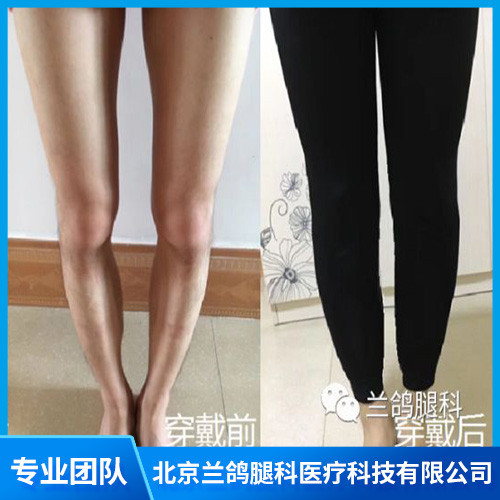 腿部塑形矫正价格 兰鸽腿部塑形 成人o型腿部塑形 北京兰鸽腿科医疗科